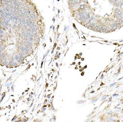 Immunohistochemistry-Paraffin: cGAS Antibody [NBP3-16666] -  Human colon carcinoma using cGAS Rabbit pAb at dilution of 1:50 (40x lens).Perform high pressure antigen retrieval with 10 mM citrate buffer pH 6.0 before commencing with IHC staining protocol.