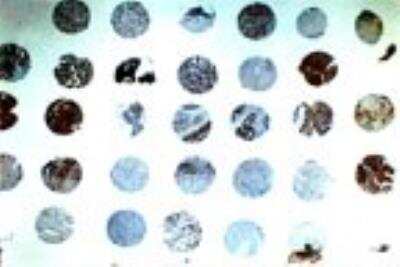 Immunohistochemistry: cIAP-1/HIAP-2 Antibody - Unpurified [NB100-56130] - cIAP-1/HIAP-2 Antibody [NB100-56130] - Analysis of a formalin-fixed, paraffin-embedded human ovarian cancer tissue microarray using this antibody at 1:2000. Differential expression of cIAP-1/HIAP-2  is seen between patient samples. Hematoxylin-eosin counterstain.