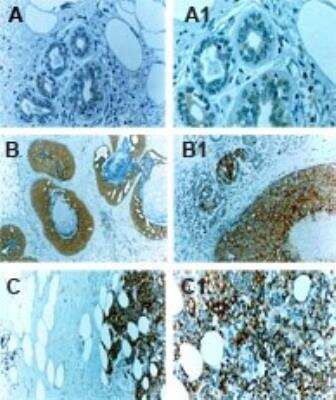 Immunohistochemistry: cIAP-1/HIAP-2 Antibody - Unpurified [NB100-56130] - cIAP-1/HIAP-2 Antibody [NB100-56130] - Analysis of formalin-fixed, paraffin-embedded human breast tissue using this antibody at 1:2000. A, normal breast tissue. B, ductal carcinoma in situ (DCIS). C, invasive breast carcinoma. A1, B1, and C1 are higher magnifications of A, B and C, respectively. Hematoxylin-eosin counterstain. Increased cIAP1 expression is seen in the cancerous compared to normal breast tissue. Hematoxylin-eosin counterstain.