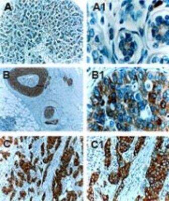 Immunohistochemistry: cIAP-2/HIAP-1 Antibody - Unpurified [NB100-56131] - cIAP-2/HIAP-1 Antibody [NB100-56131] - Analysis of cIAP-2/HIAP-1 in paraffin-embedded formalin-fixed human mammary gland (female breast) using NB100-56131 at 1:2000. A) normal breast tissue. B) ductal carcinoma in situ (DCIS). C) invasive neoplasia. cIAP2 expressed increased sucessively with tumor progression. Hematoxylin-eosin counterstain.