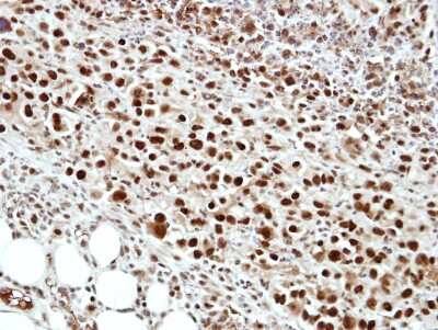 Immunohistochemistry-Paraffin: cleavage stimulation factor Antibody [NBP2-15913] - Immunohistochemical analysis of paraffin-embedded ES2 xenograft, using antibody at 1:500 dilution.