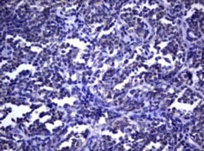 Immunohistochemistry: dedicator of cytokinesis 8 Antibody (12D7) [NBP2-46470] - Analysis of Human lymphoma tissue. (Heat-induced epitope retrieval by 1 mM EDTA in 10mM Tris, pH9.0, 120C for 3min)