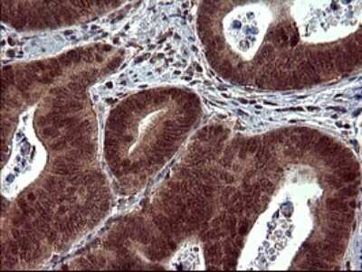 Immunohistochemistry: dedicator of cytokinesis 8 Antibody (4F3) [NBP2-46469] - Analysis of Carcinoma of Human pancreas tissue. (Heat-induced epitope retrieval by 10mM citric buffer, pH6.0, 120C for 3min)