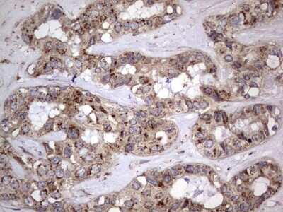 Immunohistochemistry: dedicator of cytokinesis 8 Antibody (4H10) [NBP2-46471] - Analysis of Carcinoma of Human liver tissue.(Heat-induced epitope retrieval by 1 mM EDTA in 10mM Tris, pH8.5, 120C for 3min)