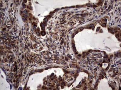 Immunohistochemistry: dedicator of cytokinesis 8 Antibody (4H10) [NBP2-46471] - Analysis of Carcinoma of Human lung tissue .(Heat-induced epitope retrieval by 1 mM EDTA in 10mM Tris, pH8.5, 120C for 3min)