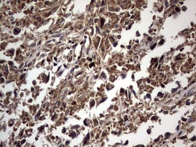 Immunohistochemistry: dedicator of cytokinesis 8 Antibody (4H10) [NBP2-46471] - Analysis of Adenocarcinoma of Human ovary tissue. (Heat-induced epitope retrieval by 1 mM EDTA in 10mM Tris, pH8.5, 120C for 3min)