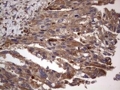 Immunohistochemistry: dedicator of cytokinesis 8 Antibody (4H10) [NBP2-46471] - Analysis of Carcinoma of Human pancreas tissue. (Heat-induced epitope retrieval by 1 mM EDTA in 10mM Tris, pH8.5, 120C for 3min)