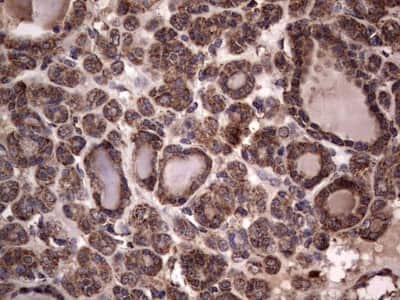 Immunohistochemistry: dedicator of cytokinesis 8 Antibody (4H10) [NBP2-46471] - Analysis of Carcinoma of Human thyroid tissue. (Heat-induced epitope retrieval by 1 mM EDTA in 10mM Tris, pH8.5, 120C for 3min)