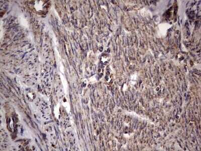 Immunohistochemistry: dedicator of cytokinesis 8 Antibody (4H10) [NBP2-46471] - Analysis of Adenocarcinoma of Human endometrium tissue. (Heat-induced epitope retrieval by 1 mM EDTA in 10mM Tris, pH8.5, 120C for 3min)