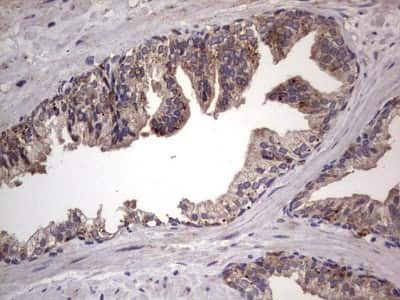 Immunohistochemistry: dedicator of cytokinesis 8 Antibody (4H10) [NBP2-46471] - Analysis of Carcinoma of Human prostate tissue. (Heat-induced epitope retrieval by 1 mM EDTA in 10mM Tris, pH8.5, 120C for 3min)