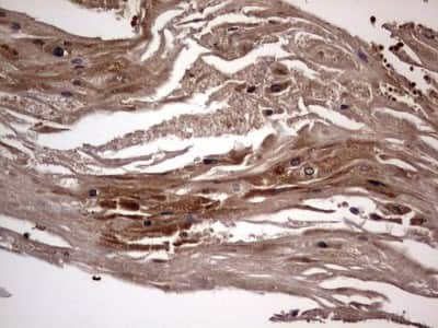 Immunohistochemistry: dedicator of cytokinesis 8 Antibody (4H10) [NBP2-46471] - Analysis of Carcinoma of Human bladder tissue. (Heat-induced epitope retrieval by 1 mM EDTA in 10mM Tris, pH8.5, 120C for 3min)