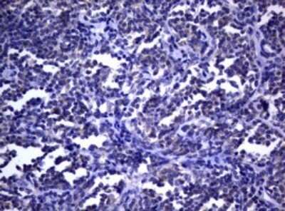 Immunohistochemistry: dedicator of cytokinesis 8 Antibody (OTI12D7) - Azide and BSA Free [NBP2-72227] - Analysis of Human lymphoma tissue. (Heat-induced epitope retrieval by 1 mM EDTA in 10mM Tris, pH9.0, 120C for 3min)