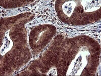 Immunohistochemistry: dedicator of cytokinesis 8 Antibody (OTI4F3) - Azide and BSA Free [NBP2-72226] - Analysis of Carcinoma of Human pancreas tissue. (Heat-induced epitope retrieval by 10mM citric buffer, pH6.0, 120C for 3min)