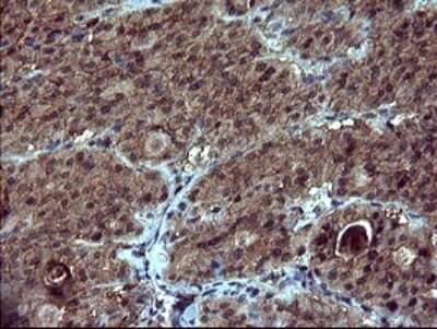 Immunohistochemistry: dedicator of cytokinesis 8 Antibody (OTI4F3) - Azide and BSA Free [NBP2-72226] - Analysis of Carcinoma of Human thyroid tissue. (Heat-induced epitope retrieval by 10mM citric buffer, pH6.0, 120C for 3min)