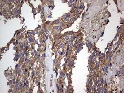 Immunohistochemistry: dedicator of cytokinesis 8 Antibody (OTI4H10) - Azide and BSA Free [NBP2-72228] - Analysis of Adenocarcinoma of Human breast tissue. (Heat-induced epitope retrieval by 1 mM EDTA in 10mM Tris, pH8.5, 120C for 3min)
