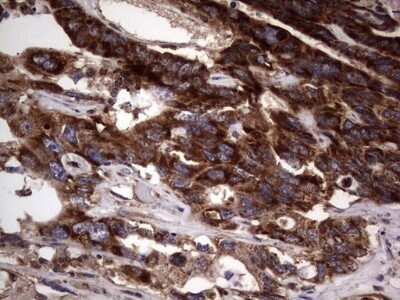Immunohistochemistry: dedicator of cytokinesis 8 Antibody (OTI4H10) - Azide and BSA Free [NBP2-72228] - Analysis of Adenocarcinoma of Human colon tissue. (Heat-induced epitope retrieval by 1 mM EDTA in 10mM Tris, pH8.5, 120C for 3min)