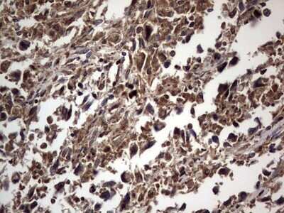 Immunohistochemistry: dedicator of cytokinesis 8 Antibody (OTI4H10) - Azide and BSA Free [NBP2-72228] - Analysis of Adenocarcinoma of Human ovary tissue. (Heat-induced epitope retrieval by 1 mM EDTA in 10mM Tris, pH8.5, 120C for 3min)