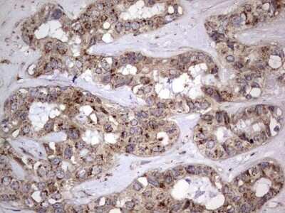 Immunohistochemistry: dedicator of cytokinesis 8 Antibody (OTI4H10) - Azide and BSA Free [NBP2-72228] - Analysis of Carcinoma of Human liver tissue.(Heat-induced epitope retrieval by 1 mM EDTA in 10mM Tris, pH8.5, 120C for 3min)
