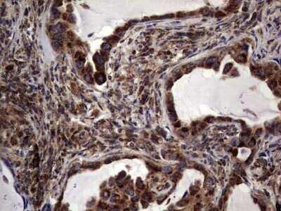 Immunohistochemistry: dedicator of cytokinesis 8 Antibody (OTI4H10) - Azide and BSA Free [NBP2-72228] - Analysis of Carcinoma of Human lung tissue .(Heat-induced epitope retrieval by 1 mM EDTA in 10mM Tris, pH8.5, 120C for 3min)