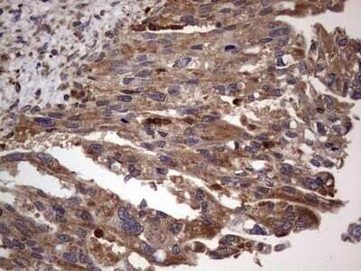 Immunohistochemistry: dedicator of cytokinesis 8 Antibody (OTI4H10) - Azide and BSA Free [NBP2-72228] - Analysis of Carcinoma of Human pancreas tissue. (Heat-induced epitope retrieval by 1 mM EDTA in 10mM Tris, pH8.5, 120C for 3min)
