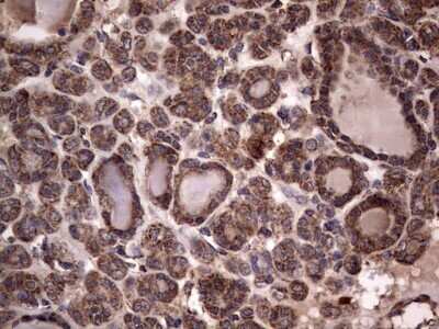 Immunohistochemistry: dedicator of cytokinesis 8 Antibody (OTI4H10) - Azide and BSA Free [NBP2-72228] - Analysis of Carcinoma of Human thyroid tissue. (Heat-induced epitope retrieval by 1 mM EDTA in 10mM Tris, pH8.5, 120C for 3min)