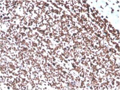 Immunohistochemistry-Paraffin: dsDNA Antibody (DSD/4054R) - Azide and BSA Free [NBP3-08490] - Formalin-fixed, paraffin-embedded human colon carcinoma stained with dsDNA Recombinant Rabbit Monoclonal Antibody (DSD/4054R).