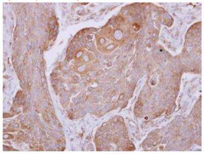 Immunohistochemistry-Paraffin: dynactin 4 Antibody [NBP2-16242] - Paraffin-embedded breast cancer.  Dynactin p62 antibody dilution: 1:500.