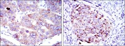 Immunohistochemistry: eEF-2 Antibody (5B6) [NBP2-37620] - Immunohistochemical analysis of paraffin-embedded liver cancer tissues (left) and kidney cancer tissues (right) using EEF2 mouse mAb with DAB staining.