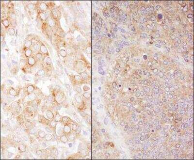 <b>Biological Strategies Validation. </b>Immunohistochemistry-Paraffin: eEF-2 Antibody [NB100-87020] - Section of human breast carcinoma (left) and mouse teratoma (right).Antibody: Affinity purified rabbit anti-eEF2 used at a dilution of 1:1,000 (0.2ug/ml). Detection: DAB