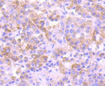 Immunohistochemistry-Paraffin: eEF1A1 Antibody (JB44-13) [NBP2-75478] - Analysis of paraffin-embedded human liver cancer tissue using anti-eEF1A1 antibody. Counter stained with hematoxylin.