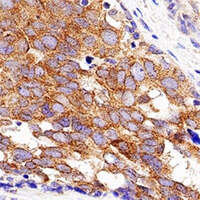 Immunohistochemistry-Paraffin: eIF2A Antibody (3A7B11) [NBP2-26296] - IHC analysis of formalin fixed paraffin-embedded (FFPE) human breast cancer using eIF2A (3A7B11) antibody at 1:200 on a Bond Rx autostainer (Leica Biosystems). The assay involved 20 minutes of heat induced antigen retrieval (HIER) using 10mM sodium citrate buffer (pH 6.0) and endogenous peroxidase quenching with peroxide block. The sections were incubated with primary antibody for 30 minutes and Bond Polymer Refine Detection (Leica Biosystems) with DAB was used for signal development followed by counterstaining with hematoxylin. Whole slide scanning and capturing of representative images was performed using Aperio AT2 (Leica Biosystems). Cytoplasmic and perinuclear staining was observed. Staining was performed by Histowiz.