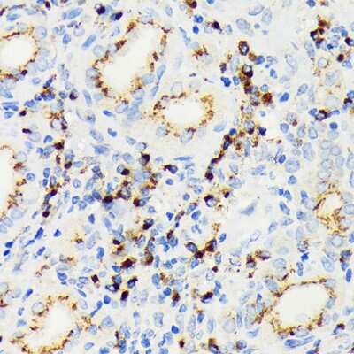 Immunohistochemistry-Paraffin: eIF2A Antibody (8V8H7) [NBP3-16864] - Immunohistochemistry of paraffin-embedded human thyroid cancer using eIF2A Rabbit mAb (NBP3-16864) at dilution of 1:100 (40x lens).Perform microwave antigen retrieval with 10 mM Tris/EDTA buffer pH 9.0 before commencing with IHC staining protocol.