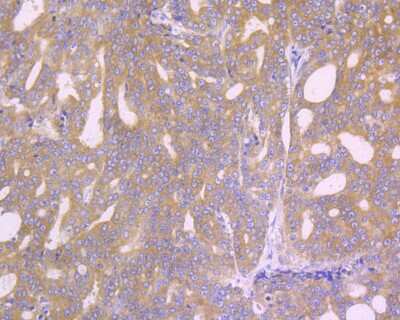 Immunohistochemistry-Paraffin: eIF2A [p Ser51] Antibody (SZ01-06) [NBP2-67353] - Immunohistochemical analysis of paraffin-embedded human prostate carcinoma tissue using anti-eIF2A antibody. The section was pre-treated using heat mediated antigen retrieval with Tris-EDTA buffer (pH 8.0-8.4) for 20 minutes. The tissues were blocked in 5% BSA for 30 minutes at room temperature, washed with ddH2O and PBS, and then probed with the primary antibody (ET1603-14, 1/50) for 30 minutes at room temperature. The detection was performed using an HRP conjugated compact polymer system. DAB was used as the chromogen. Tissues were counterstained with hematoxylin and mounted with DPX.