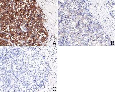 Immunohistochemistry-Paraffin: eIF2A [p Ser51] Antibody (SZ01-06) [NBP2-67353] - Analysis of paraffin-embedded human breast carcinoma tissue with Rabbit anti-elF2A [p Ser51] antibody washed with ddH2O and PBS, and then probed with the primary antibody at 1/200 dilution for 1 hour at room temperature. The detection was performed using an HRP conjugated compact polymer system. DAB was used as the chromogen. Tissues were counterstained with hematoxylin and mounted with DPX.