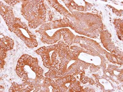 Immunohistochemistry-Paraffin: eIF4A1 Antibody [NBP2-16302] -  Human colon carcinoma, using EIF4A1 antibody at 1:500 dilution.  Antigen Retrieval: Trilogy™ (EDTA based, pH 8.0) buffer, 15min