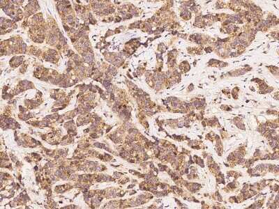 Immunohistochemistry-Paraffin: eIF4E Antibody [NBP2-98867] - Immunochemical staining of human eIF4E in human breast carcinoma with rabbit polyclonal antibody at 1:300 dilution, formalin-fixed paraffin embedded sections.