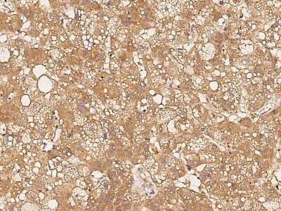 Immunohistochemistry-Paraffin: eIF4E Antibody [NBP2-98867] - Immunochemical staining of human eIF4E in human hepatoma with rabbit polyclonal antibody at 1:300 dilution, formalin-fixed paraffin embedded sections.