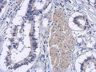 Immunohistochemistry-Paraffin: eIF5A2 Antibody [NBP2-16312] - Immunohistochemical analysis of paraffin-embedded Gastric carcinoma, using antibody at 1:500 dilution.