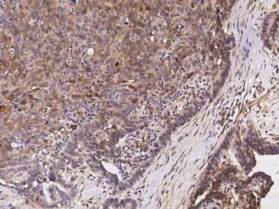 Immunohistochemistry-Paraffin: eIF5A2 Antibody [NBP2-96988] - Immunochemical staining of human eIF5A2 in human ovarian cancer with rabbit polyclonal antibody at 1:10000 dilution, formalin-fixed paraffin embedded sections.