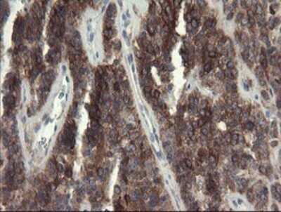 Immunohistochemistry: eIF5A2 Antibody (OTI6G7) [NBP2-45697] - Analysis of Carcinoma of Human pancreas tissue.