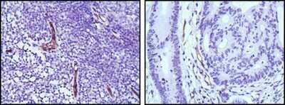 Immunohistochemistry-Paraffin: eNOS Antibody (6H2) - Azide and BSA Free [NBP2-80720] - Immunohistochemical analysis of paraffin-embedded human lymph node (left) and colon cancer (right) tissues using eNOS mouse mAb with DAB staining. Image from the standard format of this antibody.