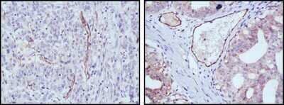 Immunohistochemistry-Paraffin: eNOS Antibody (6H2) - Azide and BSA Free [NBP2-80720] - Immunohistochemical analysis of paraffin-embedded human stomach cancer (left) and ovary cancer (right) tissues using eNOS mouse mAb with DAB staining. Image from the standard format of this antibody.