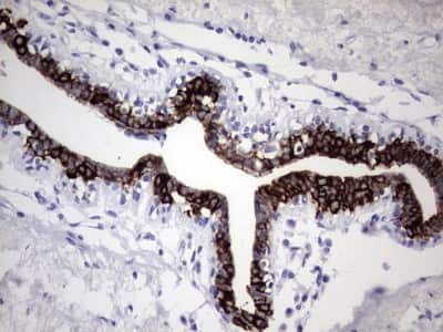 Immunohistochemistry: enkurin Antibody (6C10) [NBP2-45428] - Analysis of Adenocarcinoma of Human breast tissue. (Heat-induced epitope retrieval by 1 mM EDTA in 10mM Tris, pH8.5, 120C for 3min)