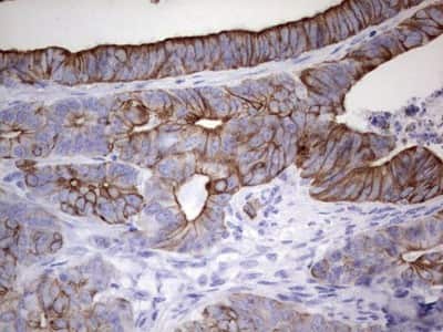 Immunohistochemistry: enkurin Antibody (6C10) [NBP2-45428] - Analysis of Adenocarcinoma of Human colon tissue. (Heat-induced epitope retrieval by 1 mM EDTA in 10mM Tris, pH8.5, 120C for 3min)