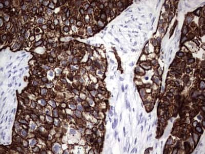 Immunohistochemistry: enkurin Antibody (6C10) [NBP2-45428] - Analysis of Carcinoma of Human kidney tissue. (Heat-induced epitope retrieval by 1 mM EDTA in 10mM Tris, pH8.5, 120C for 3min)