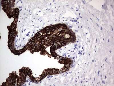 Immunohistochemistry: enkurin Antibody (6C10) [NBP2-45428] - Analysis of Carcinoma of Human prostate tissue. (Heat-induced epitope retrieval by 1 mM EDTA in 10mM Tris, pH8.5, 120C for 3min)