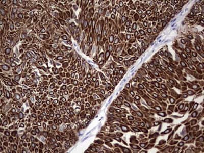 Immunohistochemistry: enkurin Antibody (6C10) [NBP2-45428] - Analysis of Carcinoma of Human bladder tissue. (Heat-induced epitope retrieval by 1 mM EDTA in 10mM Tris, pH8.5, 120C for 3min)