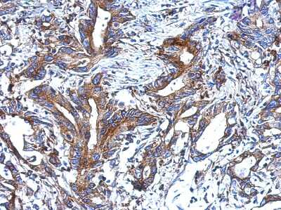 Immunohistochemistry-Paraffin: epithelial Sodium Channel alpha Antibody [NBP2-16353] - Immunohistochemical analysis of paraffin-embedded Colon ca, using antibody at 1:500 dilution.