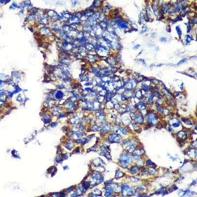 Immunohistochemistry-Paraffin: espin Antibody [NBP3-03768] - Immunohistochemistry of paraffin-embedded Human colon carcinoma using espin Rabbit pAb (NBP3-03768) at dilution of 1:100 (40x lens). Perform microwave antigen retrieval with 10 mM PBS buffer pH 7.2 before commencing with IHC staining protocol.