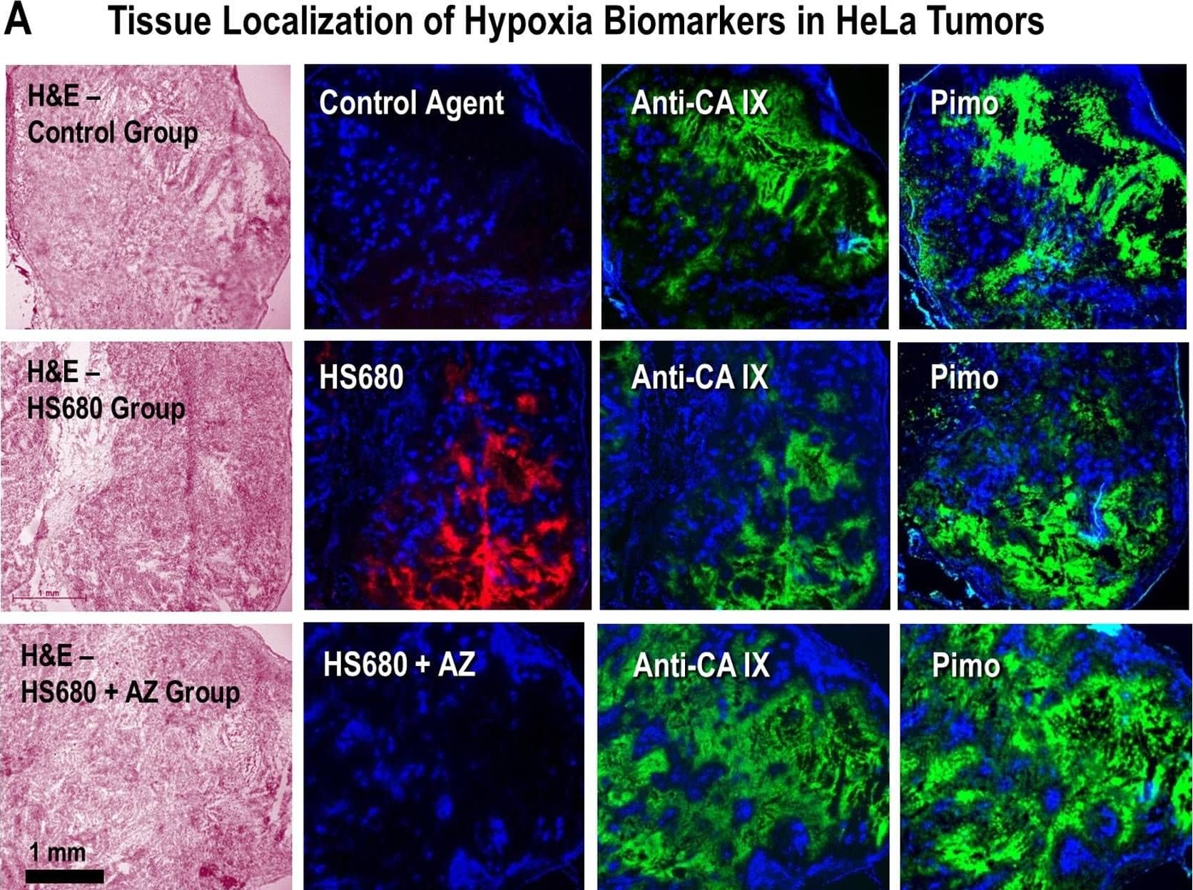 Localization of HS680 and tumor hypoxia markers in HeLa xenografts. A, The tissue staining patterns of the control agent, HS680, and HS680+AZ (red) from the same or adjacent tumor sections as staining with fluorescent CA IX antibody or pimonidazole (green) and the Hoechst perfusion stain (blue). H&E staining of tissue sections that were used for localization are shown on the left side of images. HS680 was specifically localized in regions with low Hoechst staining indicative of low oxygen (less perfused) but positive staining with both the CA IX antibody and Pimonidazole. Preinjection of the mice with unlabeled AZ blocked the binding of HS680 to control levels. B, Co-localization (overlay) of HS680 with CA IX antibody or pimonidazole (hypoxyprobe) is shown on the right side images indicating HS680 was clearly co-localized with both anti-CA IX antibody and hypoxyprobe (pimonidazole). Similar results were obtained using HT-29 tumors (Figure S4A and Figure S4B). Image collected and cropped by CiteAb from the following open publication (//pubmed.ncbi.nlm.nih.gov/23226406), licensed under a CC-BY license. Not internally tested by R&D Systems.